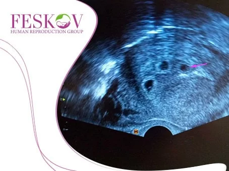 blog: Gemelli e trigemelli: La probabilità di nascite multiple con la maternità surrogata immagine